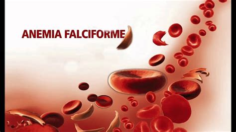 A Anemia Falciforme An Lises Cl Nicas