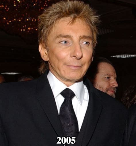 Barry Manilow Plastic Surgery Before And After