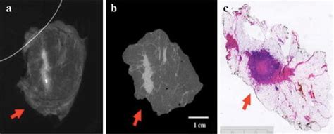 A Tumor Mass In Lumpectomy Specimen Radiograph Appears Distant From The