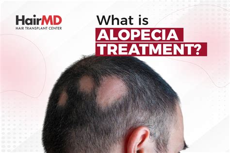 Alopecia Areata Treatment For Men