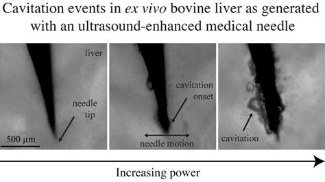 Ultrasound Combined With Fine Needles For Better Biopsy Results Inews