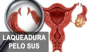 Cirurgia De Laqueadura Pelo Sus Como Fazer Gr Tis