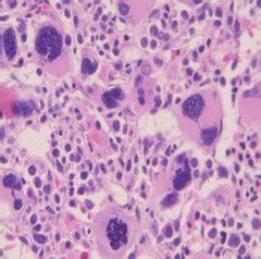 Acute Leukemia: Acute Monocytic Leukemia Prognosis