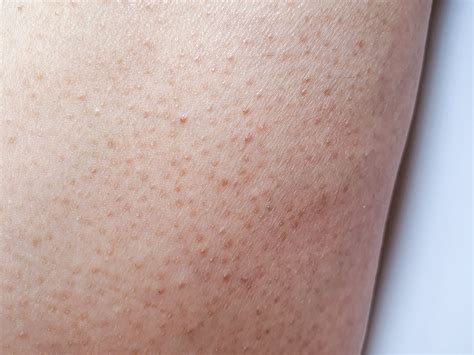 What Is Keratosis Pilaris And How To Get Rid Of It Ask The Skin Care E Beauty Kin