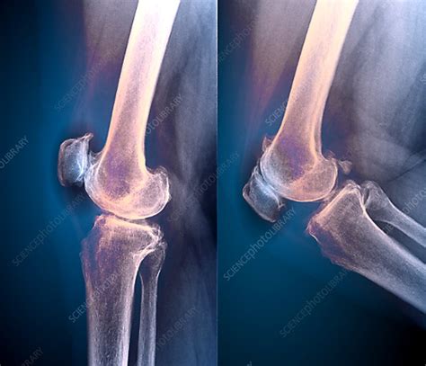 Osteoarthritis Of The Knee X Ray | Images and Photos finder