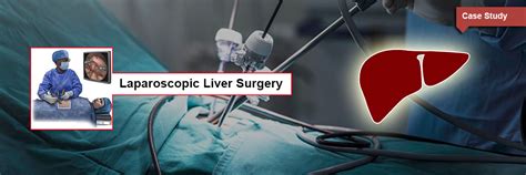 Laparoscopic Surgery Laparoscopic Surgery For Liver Tumor Laparoscopic Liver Surgery