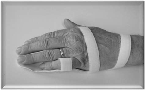 Hand Splint For Dupuytren S Contracture Online Stores