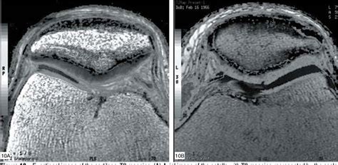 Figure 5 from MRI EVALUATION OF KNEE CARTILAGE | Semantic Scholar