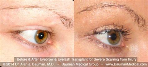 Eyebrow Scar Hair Transplant · Bauman Medical