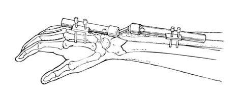 Image:External Fixator-Merck Manual Consumer Version