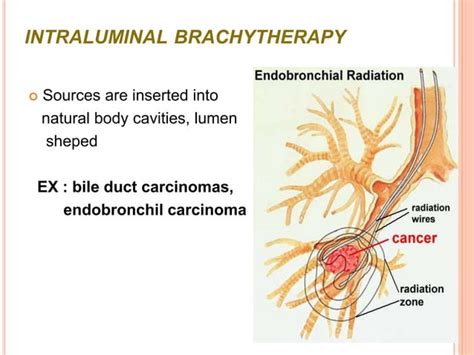 Brachytherapy.ar