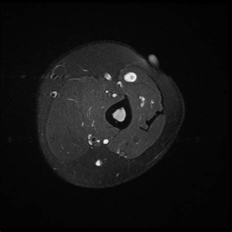 Nerve Sheath Tumor Ultrasound