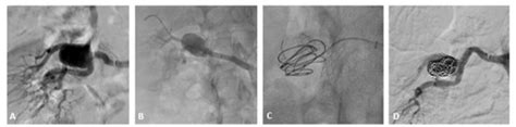 A Arteriografia Renal Demonstrando Aneurisma Renal Tipo Ii Complexo