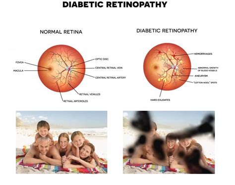 Diabetic Retinopathy Invision Optometry