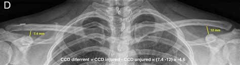 Postoperative Ac Joint Bilateral Ap X Ray The Ccd Of Both Shoulders