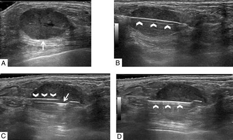 Ultrasound‐guided Breast Biopsies Bhatt 2021 Journal Of