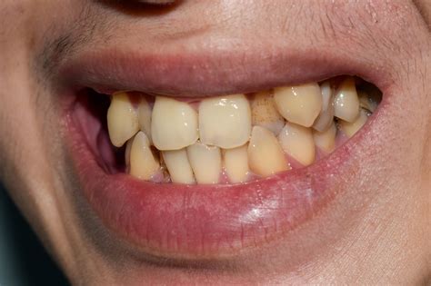 Different Types Of Crooked Teeth