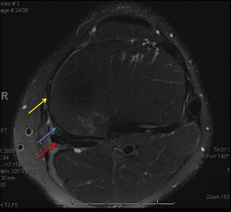 Oblique Popliteal Ligament Mri