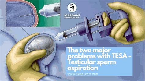 The 2 Major Problems With Tesa Testicular Sperm Aspiration Drmalpani