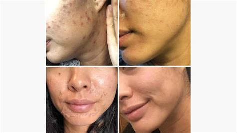 Chemical Peel Side Effects Atelier Yuwaciaojp