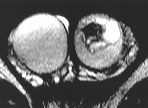 Sonographic And Mr Imaging Findings Of Testicular Epidermoid Cysts Ajr