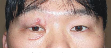 Figure 3 From A Case Of Scar Sarcoidosis Of The Eyelid Semantic Scholar