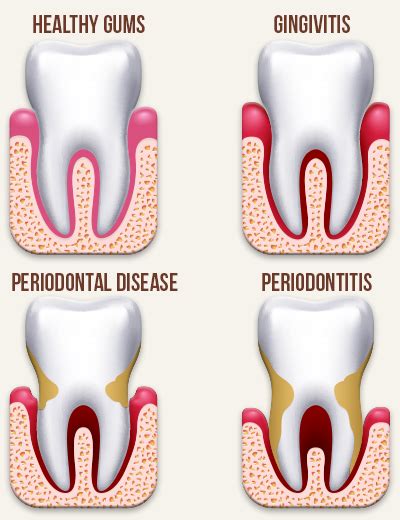 8 Easy Facts About What Your Gums Say About Your Oral Health Todays