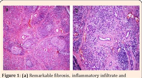 Figure 1 From Kuttners Tumor Of Bilateral Submandibular And Parotid