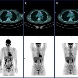 Fdg Pet Findings At A Baseline Fdg Pet B Interim Fdg Pet Abvd