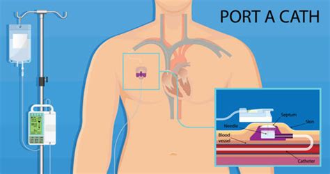 central venous access devices lymphoma australia