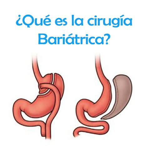 Qué es la cirugía bariátrica Vida sana con Shigo