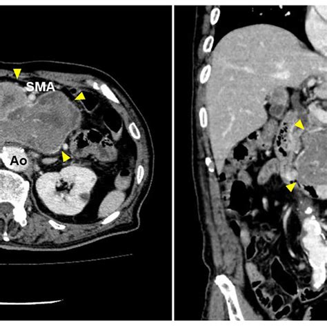 Abdominal Contrast Enhanced Computed Tomography Left An Axial Slice