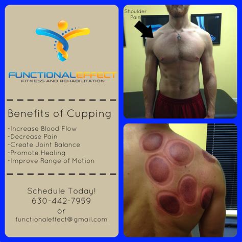 List 98 Pictures Pictures Of Cupping Therapy Completed