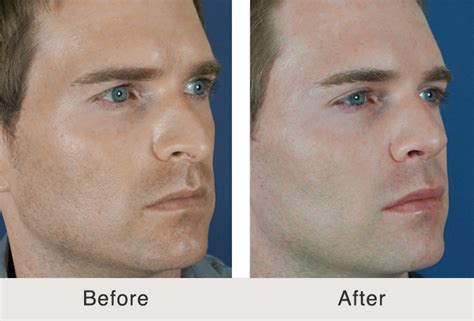 Before After Male Filler Temples And Tear Trough Carolina Facial