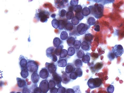 Fna Of Metastatic Papillary Thyroid Carcinoma Showing Characteristic