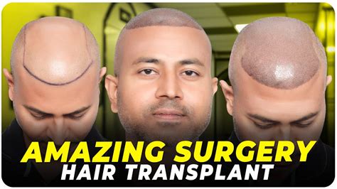 Hair Transplant In Gwalior Best Results Cost Of Hair Transplant In