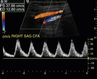 Ultrasound Assessment of the Abdominal Aorta | Radiology Key