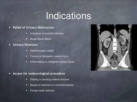 PPT - Nephrostomy PowerPoint Presentation, free download - ID:3591020