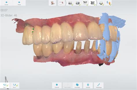 Ohne Abdruck Digitaler Zahnersatz Mit Intraoral Scanner