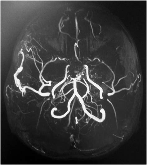 Magnetic Resonance Angiography Mra Brain Mra Showing The Occlusion