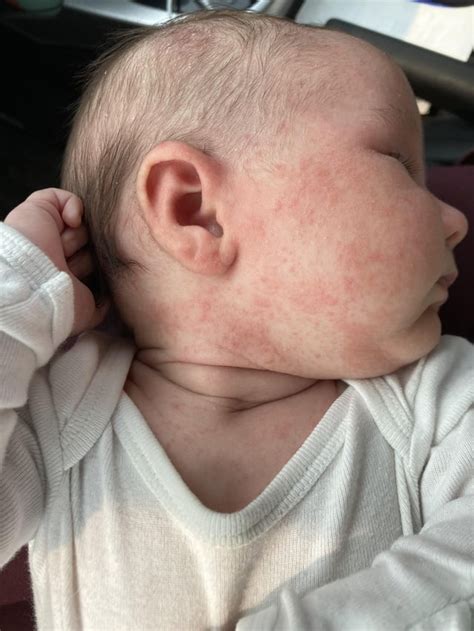 Yeast Rash Or Eczema Rnewborns