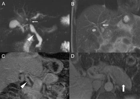 IgG4-related sclerosing cholangitis in a 59-year-old man with ...