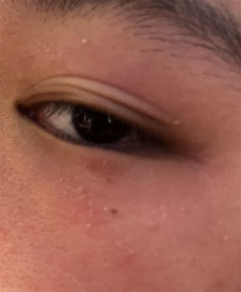 Skin Around Eyes Is Red And Peeling Rmedical