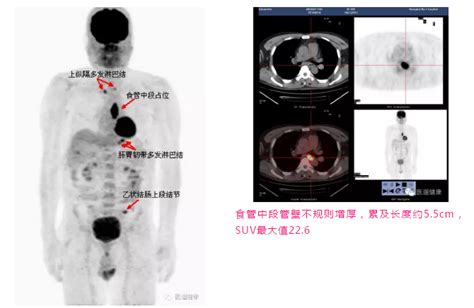 Pet Ct检查petct价格petct医院预约中心医生在线