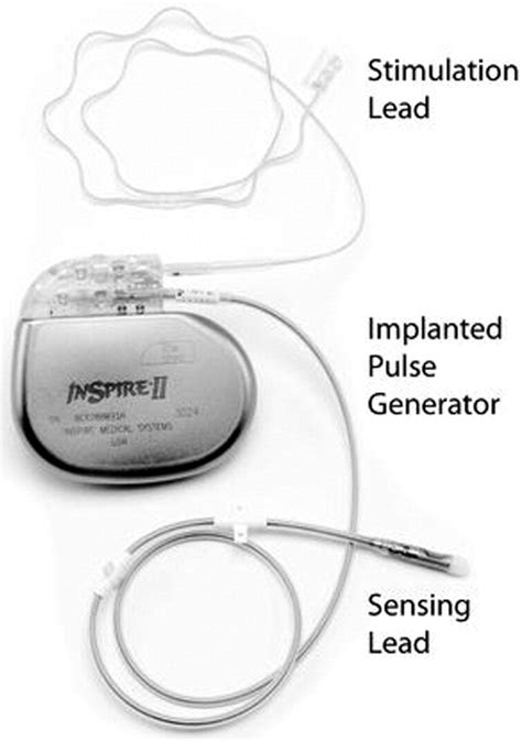 Operative Technique Of Upper Airway Stimulation An Implantable