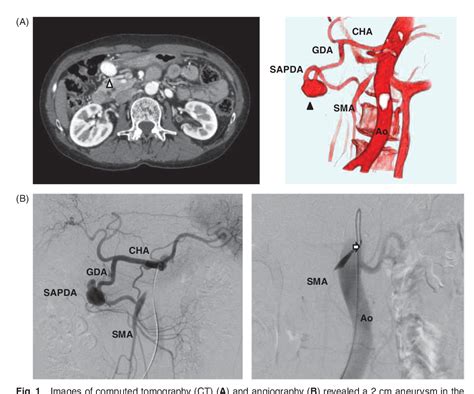 Figure 1 From Pancreaticoduodenal Artery Aneurysm Formation With