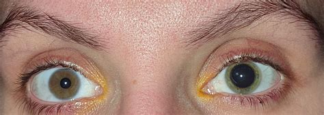 One of my pupils won't dilate : r/mildlyinteresting