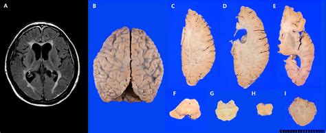 PDF Adult Onset Leukoencephalopathy With Axonal Spheroid And