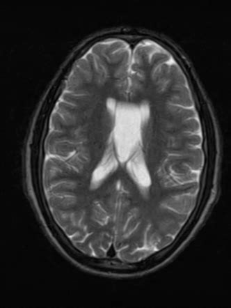 Cavum Septum Pellucidum And Vergae Radiology Case Radiopaedia Org