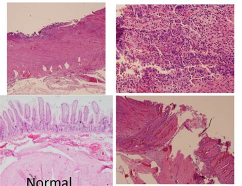 Pathology Exam Gi Flashcards Quizlet